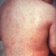 Measles cases rising again globally: Report